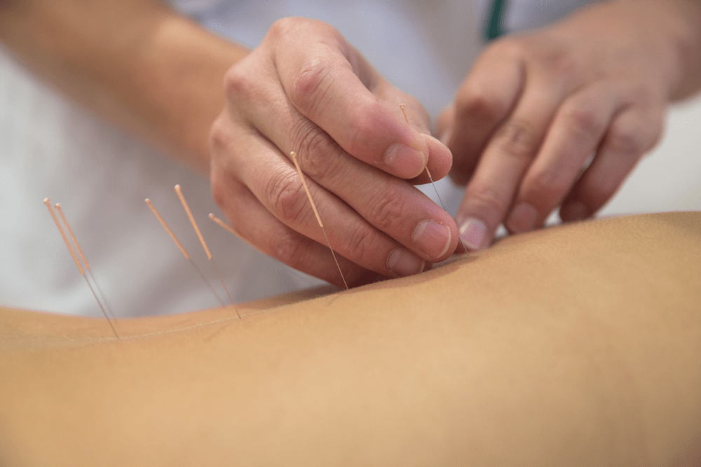 Photo d'aiguilles lors d'une séance d'acupuncture